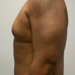 Hi Def Liposuction Before & After Patient #4634