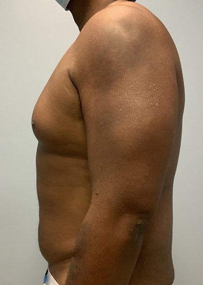 Hi Def Liposuction Before & After Patient #4634