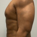 Hi Def Liposuction Before & After Patient #4634