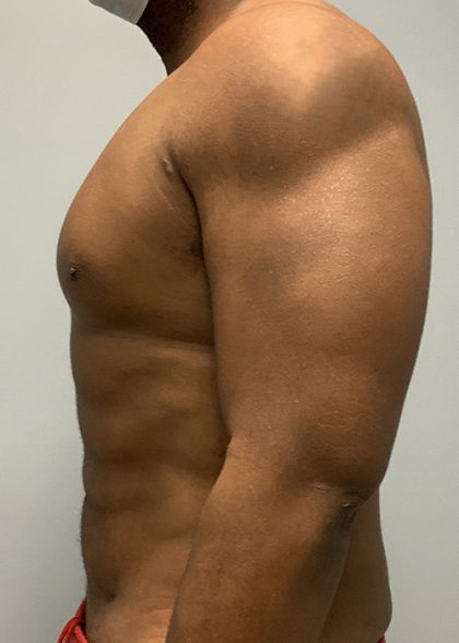 Hi Def Liposuction Before & After Patient #4634