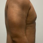 Hi Def Liposuction Before & After Patient #4634