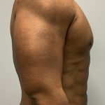 Hi Def Liposuction Before & After Patient #4634