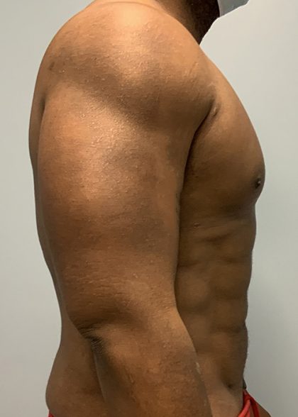 Hi Def Liposuction Before & After Patient #4634