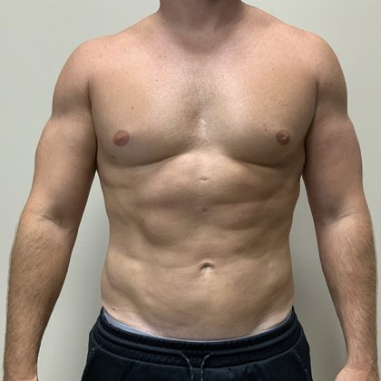 Hi Def Liposuction Before & After Patient #4641