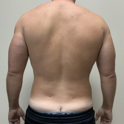 Hi Def Liposuction Before & After Patient #4641