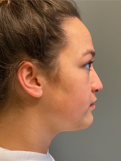 Rhinoplasty Before & After Patient #5149