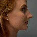 Rhinoplasty Before & After Patient #5150