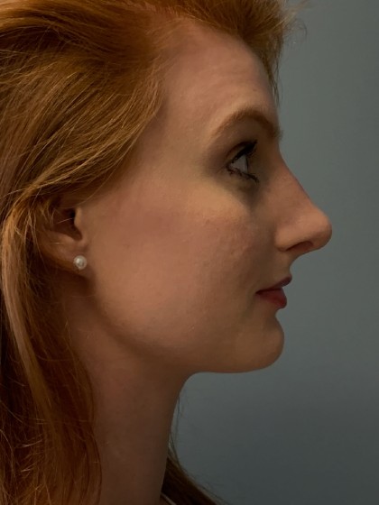 Rhinoplasty Before & After Patient #5150