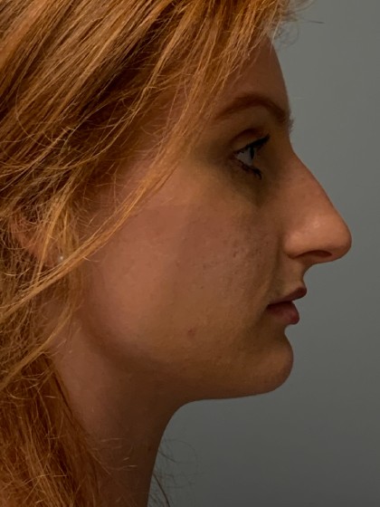 Rhinoplasty Before & After Patient #5150