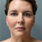 Deep Plane Facelift Before & After Patient #5238