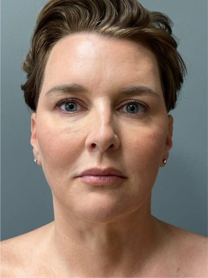 Deep Plane Facelift Before & After Patient #5238