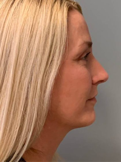 Blepharoplasty Before & After Patient #5239