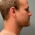 Deep Plane Neck Lift Before & After Patient #5163