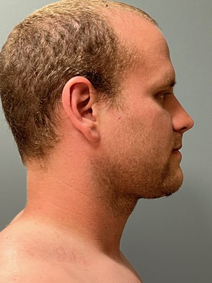 Deep Plane Neck Lift Before & After Patient #5163