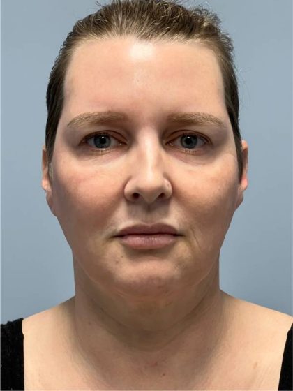 Deep Plane Facelift Before & After Patient #5238