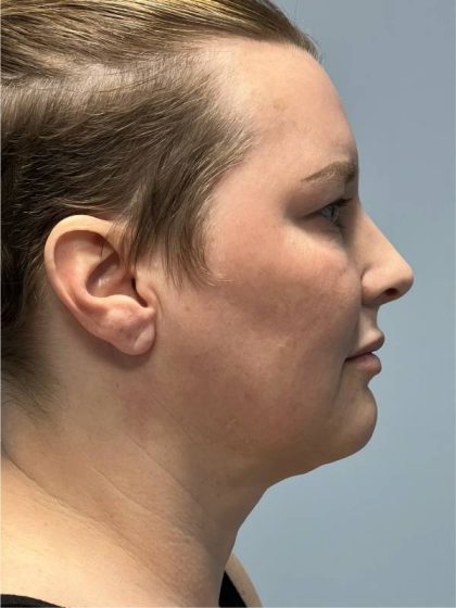 Deep Plane Facelift Before & After Patient #5238