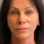 Deep Plane Facelift Before & After Patient #5237