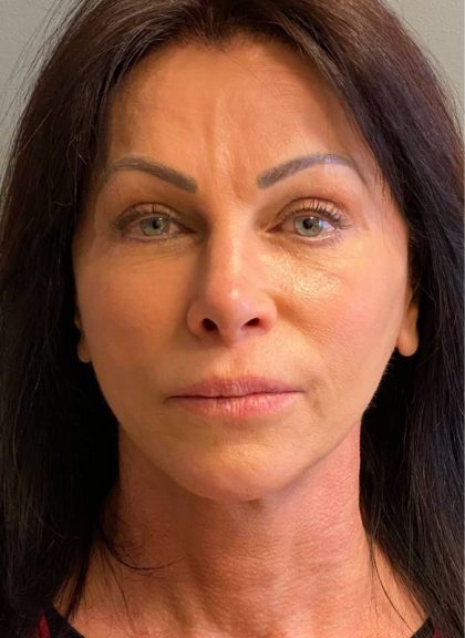 Deep Plane Facelift Before & After Patient #5237