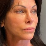 Deep Plane Facelift Before & After Patient #5237