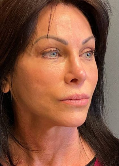 Deep Plane Facelift Before & After Patient #5237