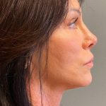 Deep Plane Facelift Before & After Patient #5237