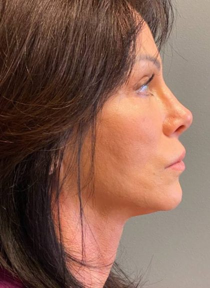 Deep Plane Facelift Before & After Patient #5237