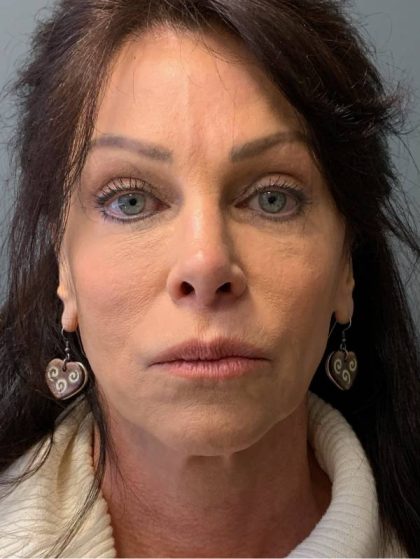 Deep Plane Facelift Before & After Patient #5237