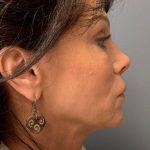 Deep Plane Facelift Before & After Patient #5237