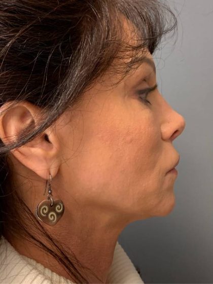 Deep Plane Facelift Before & After Patient #5237