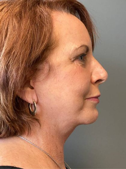 Deep Plane Facelift Before & After Patient #5236