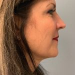 Deep Plane Facelift Before & After Patient #5235