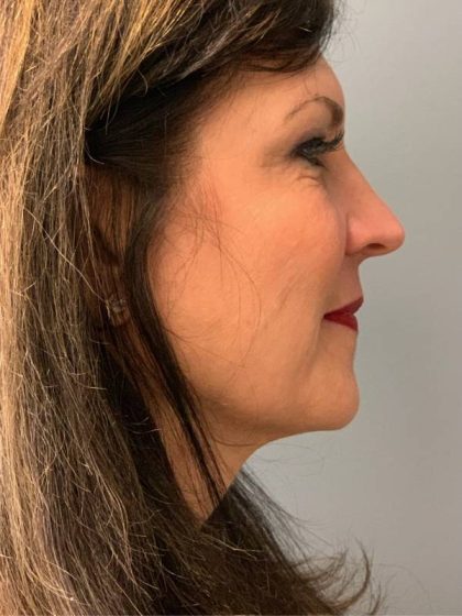 Deep Plane Facelift Before & After Patient #5235