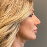 Deep Plane Facelift Before & After Patient #5233