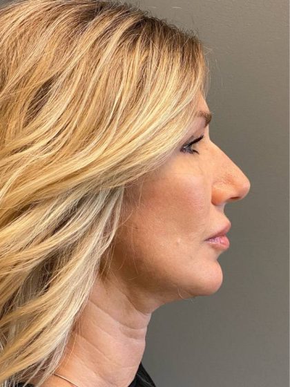 Deep Plane Facelift Before & After Patient #5233