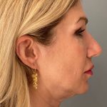 Deep Plane Facelift Before & After Patient #5233