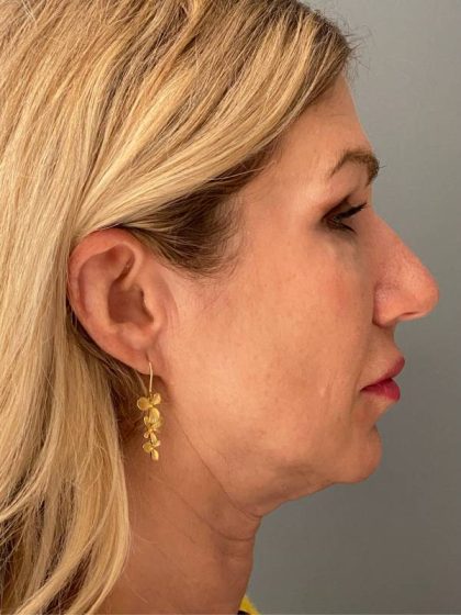 Deep Plane Facelift Before & After Patient #5233