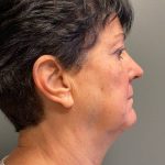 Deep Plane Facelift Before & After Patient #5234