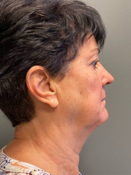 Deep Plane Facelift Before & After Patient #5234