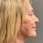 Deep Plane Facelift Before & After Patient #5185