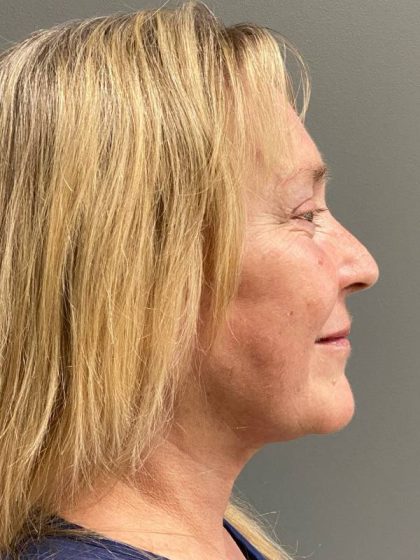 Deep Plane Facelift Before & After Patient #5185