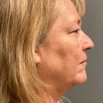 Deep Plane Facelift Before & After Patient #5185