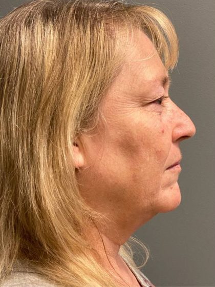 Deep Plane Facelift Before & After Patient #5185