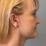 Deep Plane Facelift Before & After Patient #5182