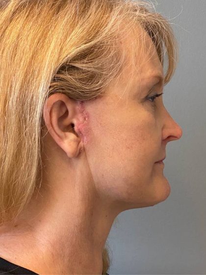 Deep Plane Facelift Before & After Patient #5182