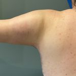 Arm Lift (Scarless Arm Lift) Before & After Patient #5411