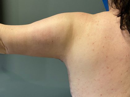 Arm Lift (Scarless Arm Lift) Before & After Patient #5411