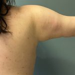 Arm Lift (Scarless Arm Lift) Before & After Patient #5411