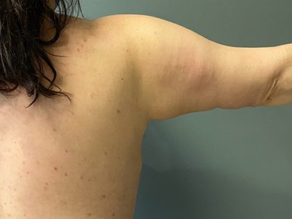 Arm Lift (Scarless Arm Lift) Before & After Patient #5411
