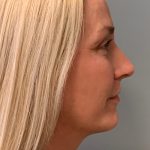 Blepharoplasty Before & After Patient #5458