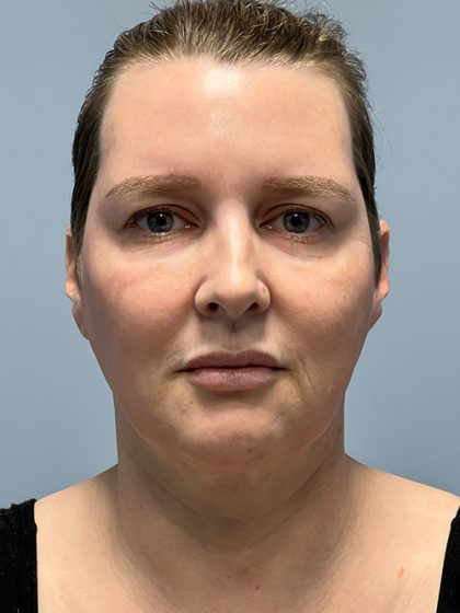 Deep Plane Facelift Before & After Patient #5460